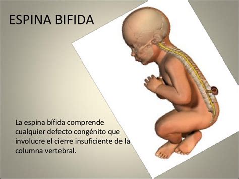 que es la espina bifida en bebes